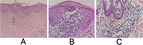 Figure 2 (A–C) Histological features ((A): HE x40, (B and C): HE x400).