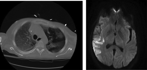 Figure 1. CT chest showing bilateral lobar pneumonia.