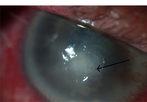 Figure 1 Photograph showing active ulceration and presence of fibrils on ulcer base (indicated by arrow head).