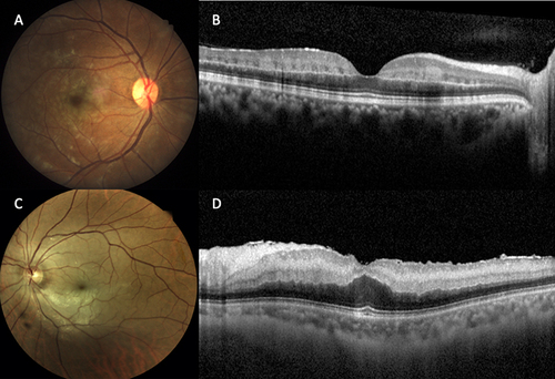 Figure 1 (A) Fundus photo of incomplete central retinal artery occlusion (CRAO) patient presented with counting finger vision showing mild scatter retinal opacity at macular area. (B) Spectral domain optical coherence tomography (SD-OCT) imaging showed increase hyperreflectivity and thickening of inner retina markedly at inner nuclear layer with relatively sparing ganglion cell layer. (C) Fundus photo of subtotal CRAO patient presented with hand motion vision showing more prominent whitening and opacity of central retina. (D) SD-OCT revealed mark thickening with increase hyperreflectivity throughout inner retina layer.