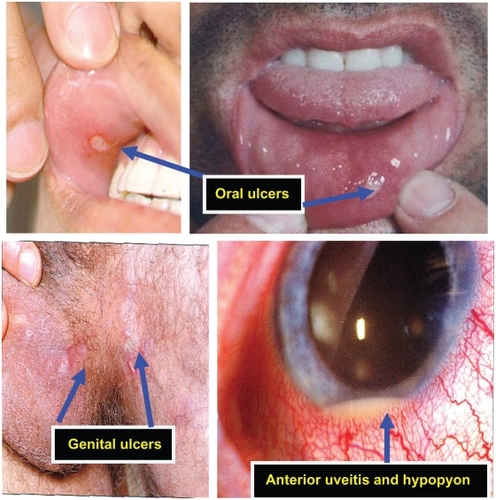 Figure 1 Triple symptom complex commonly observed in Behcet’s disease: Aphthous ulceration, iridocyclitis, and genital ulceration. Aphthous ulceration often appears as the first symptom, ie, a painful, oval or round, shallow or deep, 1–20 mm lesion with central whitish or yellowish necrotic base and red halo. Almost always present during flares, and may precede other features by years. Iridocyclitis and ocular disease is usually more bilateral than unilateral, with anterior uveitis and hypopyon commonly observed. Retinal involvement may also be present, ie, retinal vasculitis/optic neuritis or atrophy and genital ulceration, which are similar in appearance and usually present as large ulcers which are deep and often cause scarring.