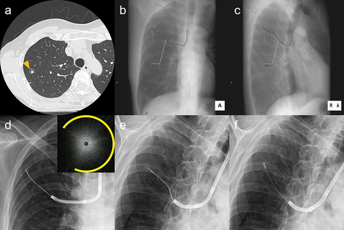 Figure 2. High-resolution computed tomography (a) showing a 9.9-mm part-solid nodule in the right S3 (arrow head). Virtual fluoroscopy, overlaying the target lesion (arrow) and the pre-planned bronchial path toward it, was reconstructed from HRCT: anteroposterior (b) and right anterior 45-degree oblique views (c). The lesion was invisible on actual fluoroscopy: anteroposterior (d) and right anterior 45-degree oblique views (e), but was approached while being matched with the path on the VF. A radial endobronchial ultrasound image of a blizzard sign adjacent to the lesion (upper right corner of d, arc indicating expanded range of the snowstorm appearance) was detected. Cryobiopsy (f) at the location revealed lung adenocarcinoma, which was later proved to be minimally invasive by the partial resection This is one of the cases included in reference 69. (Unpublished data obtained from studies approved by the National Cancer Center Institutional Review Board (No. 2018-090). Comprehensive research consent was obtained from the patient and individual consent for this publication was waived.)