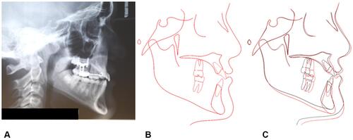 Figure 12 Final records of the patient. (A) Final lateral headfilm. (B) Final cephalometric tracing. (C) Superimposition of pre-treatment (black) and post-treatment (red) cephalometric tracings on anterior cranial base at Sella.