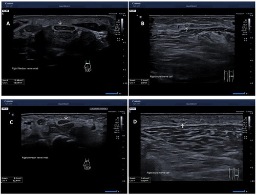 Figure 1. Ultrasound images in a patient with hereditary transthyretin amyloidosis (A) of the median nerve at the wrist, proximal to the carpal tunnel, (B) of the sural nerve, and in a healthy control (C) of the median nerve at the wrist, proximal to the carpal tunnel, (D) of the sural nerve. Arrows showing the cross-section area (CSA) mm2.