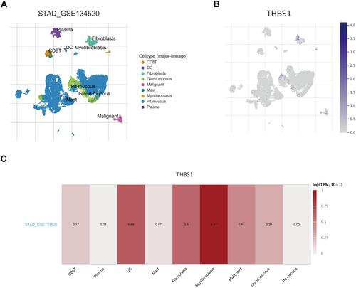 Figure 6 Correlation of THBS1 with TME in GC. (A) Cell types and distribution of STAD_GSE134520. (B) Expression and distribution of THBS1 in each cell. (C) Correlation of THBS1 expression with TME.