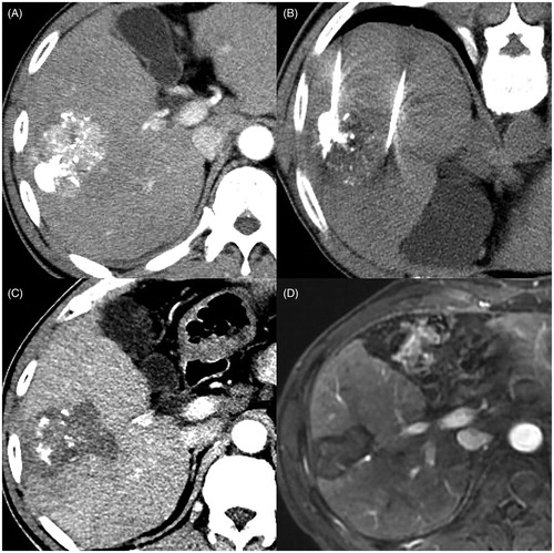 Figure 2. Images in a 64 year-old male patient with BCLC stage B hepatocellular carcinoma (HCC) before TACE, who has two lesions measuring approximately 6.1 cm and 1.0 cm (no shown), show microwave ablation (MWA) as first-line treatment after transarterial chemoembolization (TACE) refractoriness. (A) Arterial-phase CT image obtained about one month after first TACE shows that necrotic volume is less than 20% of large lesion, and small lesion disappears (no shown). (B) He underwent CT-guided multiple-position MWA for non-necrotic areas of large lesion with the output of 60 W for 69 min in total. (C) Arterial-phase CT image obtained about 1 month after MWA shows that complete ablation was achieved. (D) Arterial-phase MRI image obtained about 34 months after MWA (5 December 2019) shows no tumor recurrence.