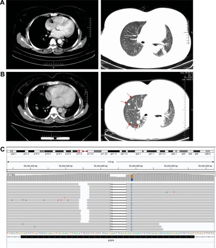 Figure 2 CT scans of the thorax prior to and following treatment with gefitinib and crizotinib.