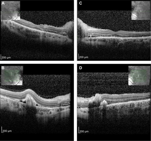 Figure 3 Optical coherence tomography 12 hours post partum.