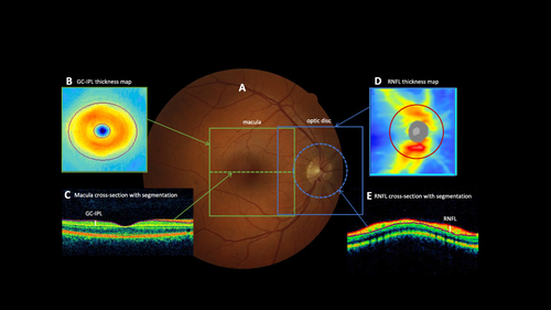 Figure 1 Retinal measurements of optic nerve structure. (A) Fundus photograph of a normal eye showing the areas scanned. (B) Ganglion cell-inner plexiform layer (GC-IPL) map showing a normal pattern. The GC-IPL thickness used for analysis was the average across the donut shaped area between the two ovals. (C) OCT cross-section through the fovea (indicated on main photo by dotted line), with automated segmentation lines showing the GC-IPL layer thickness measurement (indicated by the white line). (D) The retinal nerve fibre layer (RNFL) map shows thickest part of the nerve fibre layer close to the optic disc and at the superior and inferior Poles. The thickness is calculated on a circle of 3.5mm diameter (indicated by red line, and on main photo by dotted line). (E) The retinal cross section on the 3.5mm circle, showing automated segmentation and the RNFL thickness measurement (indicated by white line). The RNFL thickness used for analysis was the average thickness around the 3.5mm circle.