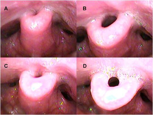 Figure 8 Drug-induced sleep endoscopy results at the epiglottis level: supine position. No intermittent negative airway pressure (iNAP) therapy during (A) inspiration and (B) expiration. Application of iNAP therapy during (C) inspiration and (D) expiration.