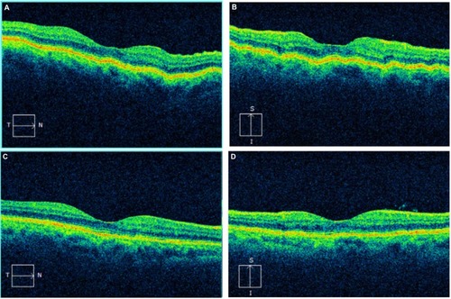 Figure 2 The horizontal line scan from the SD-OCT of the right eye of the patient demonstrates subtle chorioretinal folds (A). The vertical line scan more clearly demonstrates the chorioretinal folds (B). On both the horizontal and vertical line scans taken after treatment, there is a resolution of the folds (C and D).
