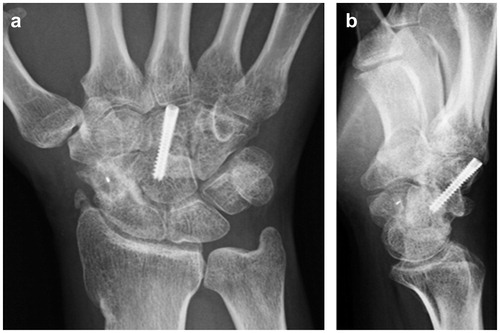Figure 5. Postoperative radiographic assessment of the hand. Radiographs showing the healing of both nonunions without evidence of arthritic changes.
