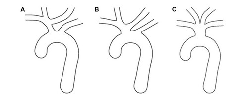 Figure 2 (A) Bovine arch – left common carotid artery originating from the innominate artery. (B) Bovine arch – common origin of the innominate artery and left common carotid artery. (C) True bovine arch.