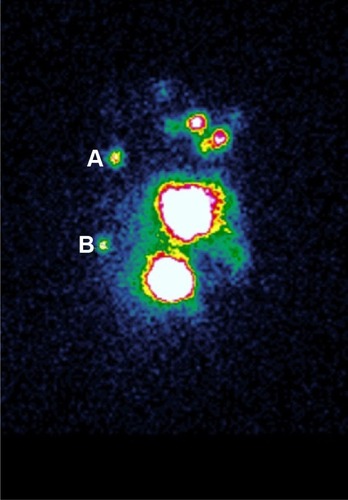 Figure 1 Lymphoscintigram 30 minutes before surgery.