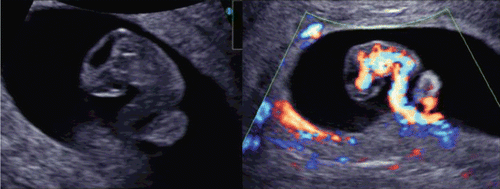 Figure 7.  Early vascular system at 7 weeks of gestation. (left) 3D gray mode. (right) 3D power Doppler with surface appearance.