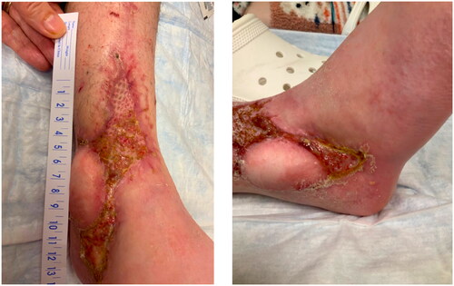 Figure 3. Right lower extremity 4-months postoperatively after flap salvage procedure.