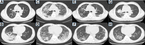 Figure 1 Patient 1 chest CT. (A and B) A n irregular solid nodule in the anterior segment of the upper lobe of the right lung and lamellar density shadows in the lower lobe of the right lung on March 20, 2018. (C and D) Multiple patchy high-density shadows are evident in both lungs, with lesions of the right upper lung still being visible during an ICU stay on June 4, 2018. (E and F) After effective antifungal therapy, the high-density shadow of the two lungs was basically absorbed, the lesion of the right upper lung was almost the same as before, and the left pleural effusion was increased on June 25, 2018. (G and H) The nodules in the right upper lobe of the lung were significantly larger, and the lesions in the lower lobes of both lungs were stable on January 15, 2019.
