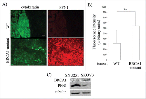 Figure 3. BRCA1 mutation is associated with increased PFN1 expression in EOC. (A) Fluorescence micrographs of WT- vs BRCA1-mutated ovarian cancer FFPE histosections stained with anti-PFN1 and anti-pan-cytokeratin antibodies. (B) Bar-graph comparing the average fluorescence intensity of PFN1 immunoreactivity between WT and BRCA1-mutated tumors (only cytokeratin-positive areas were scored) (** indicates P < 0.01). Counter-imaging of hematoxylin and eosin-stained slides further ensured that only tumor tissues were scored. (C) Total extracts of SNU-251 and SKOV3 cells were immunoblotted with anti-PFN1, and anti-tubulin (loading control) antibodies.