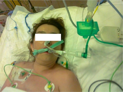 Figure 5 Patient during second series of apneic test using Boussignac CPAP system (Vygon, Ecouen, France).
