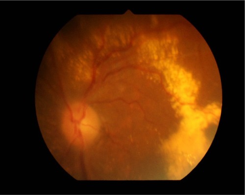 Figure 1 Idiopathic polypoidal choroidal vasculopathy with chronic subretinal exudate in a 68-year-old woman (patient 1).