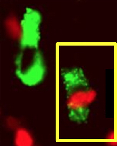 Figure 5. Photomicrograph showing co-expression of FoxP3 (red nuclear fluoresence) and TLR2 (green ring fluoresence) in the stromal cell in OSCC (cell on the lower right). Double immunofluoresence technique was used for staining of FoxP3 and TLR2 positive cells using Alexa red and green chromogen.