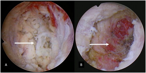 Figure 4. Hysteroscopic features after HIFU (A) and after hysteroscopic resection (B). White neoplastic tissue in the left horn of the uterus with no visual vascularity (A). The uterine lesion was completely resected under hysteroscopy (B). HIFU, high-intensity focused ultrasound; GTN, gestational trophoblastic neoplasia.