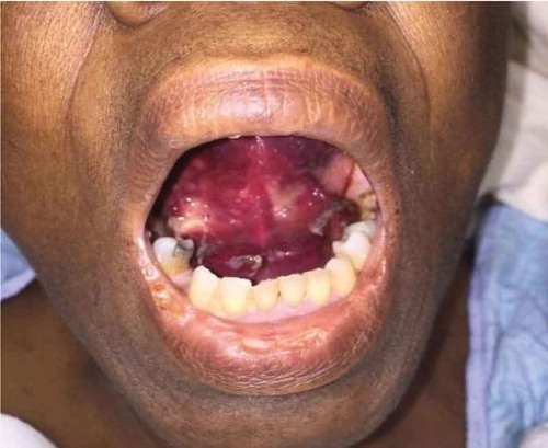 Figure 1. Demonstrating oral mucosal ecchymoses.