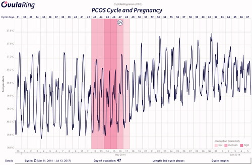 Figure 1. CFG of a patient with a PCOS. Ovulation occured at Day 47. This CFG shows a pregnancy as the core body temperature remains high.