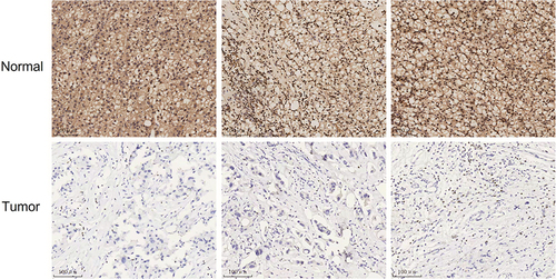 Figure 1 Analysis of GZMA protein expression in tumor and adjacent normal tissue using immunohistochemistry.