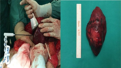 Figure 3 Left: Intraoperative photo. Microwave tissue coagulator marking the margins for hepatic segmentectomy. Right: Gross specimen photo. Hepatic segments VI and VII containing the HCC.