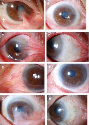 Figure 4 Preoperative and postoperative appearances in other cases. Left column, eyes before surgery and right column, after surgery. (A) A 63-year-old female had undergone pterygium surgery two times in the past. Before the surgery. (B) At 5.5 years after the surgery. Symblepharon was released and the center of the CLA became thinner (arrow), but there has been no recurrence. (C) A 72-year-old male had undergone pterygium surgery four times in the past. Before the surgery. (D) At 3 years after the surgery. (E) An 82-year-old male had undergone pterygium surgery three times in the past. Before the surgery. (F) At 2.5 years after the surgery. The conjunctival sac was shortened. (G) A 73-year-old male had undergone pterygium surgery once in the past. Before the surgery. (H) At 1 year after the surgery.