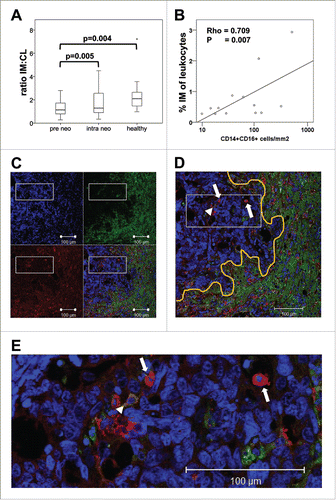 Figure 6. Monocyte migration in vitro and tumor tissue infiltration in vivo. (A) PBMCs were isolated from mCRC patients prior to neoadjuvant treatment (pre neo) or after two therapy cycles (intra neo) as compared to healthy controls (healthy). Transendothelial migration in response to tumor-derived stimuli was assessed in a transwell assay after 4 h of incubation with cell culture supernatant of colorectal cancer lines. The ratio of intermediate to classical monocytes was calculated for the transmigrated population and combined data from all transmigration assays are illustrated by boxplots. Fig. S2 illustrates migration assays separately for SW480, SW620 and HT-29 culture supernatant. Statistical analysis was based on unpaired (pre neo vs. healthy) or paired (pre neo versus intra neo) t-test. (B–E) Tissue sections of colorectal liver metastases were immunostained for CD14 and CD16 (including a DNA dye for cell nucleus detection). (C) Images acquired with a confocal laser scanning microscope show fluorescence signals for DNA in blue, CD16 in green and CD14 in red. An overlay of all three colors is enlarged in (D). The orange line indicates the border between tumor tissue and hepatocytes with high background fluorescence in the green channel. Examples for tumor-infiltrating monocytes positive for CD14 (arrow) or double-positive for CD14 and CD16 (arrow head) are highlighted. (E) A section of the image (white box) is shown in higher magnification. Immunostained tissue slides were scanned with the TissueFAXS device and subjected to automated analysis by TissueQuest software. The frequency of CD14+CD16− vs. CD14+CD16+ monocytes was determined per mm2 of tissue. Tumor area and adjacent border region were evaluated separately (Fig. S5). The correlation between tumor infiltrating CD14+CD16+ monocytes and the intermediate monocyte concentration in the blood of the same patients at the time of surgery was calculated based on Pearson´s correlation coefficient (B).