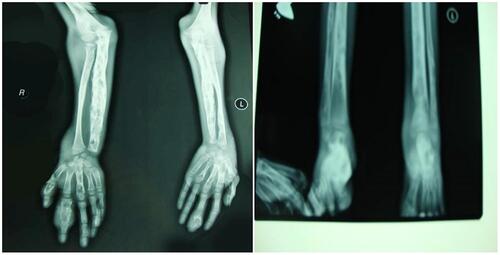 Figure 2 The X-ray images of two upper extremities and lower extremities showed decreased joint space with periarticular erosions and subluxation.