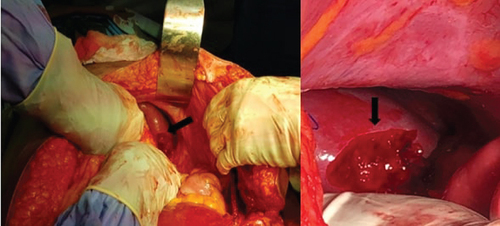 Figure 1. Splenic rupture at the splenocolic ligament insertion (arrow).