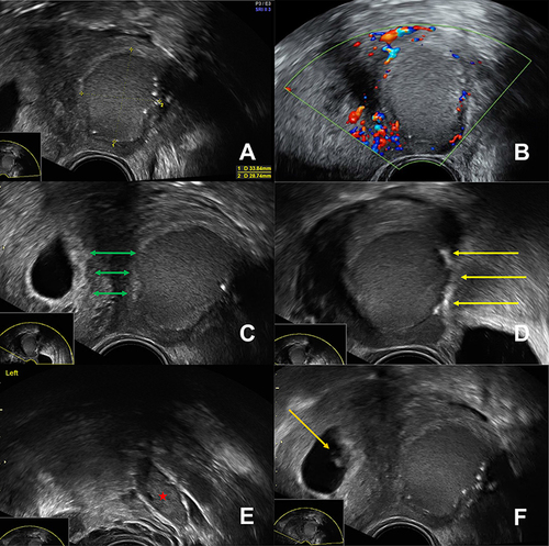 Figure 1 Ultrasound findings of the first consultation in March 2022. (A) Cystic adenomyoma within the left uterine wall, filled with a content of ground-glass echogenicity. Hyperechoic, possibly calcified spots line the inside of the cyst wall. The measurement lines show a maximum diameter of 33.8 mm. (B) On color Doppler imaging no blood flow can be detected within the cystic adenomyoma, underlining its cystic nature. (C) The cystic adenomyoma is located in the left uterine wall and has no contact with the uterine cavity (green double arrows demonstrating the distance between the uterine cavity and the cystic adenomyoma). (D) The myometrium in the area of the lateral border of the cystic adenomyoma appears to be very thin (yellow arrows). (E) Image of the left ovary (red star) demonstrating that the cyst is not ovarian in origin in the sense of an endometrioma but located in the uterine wall. (F) Normally sited, intrauterine pregnancy to the patient’s right (Orange arrow). To the patient’s left, is the cystic adenomyoma.