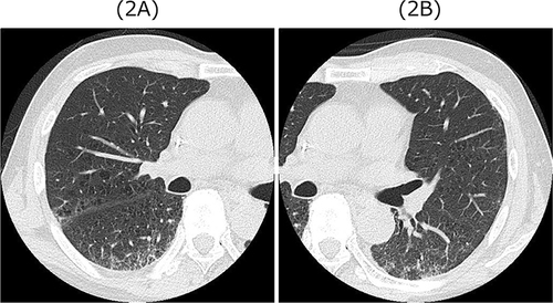 Figure 2 (A and B) Chest high resolution computed tomography findings at 20 days after admission revealed bilateral diffuse ground glass opacities improved after corticosteroid treatment.