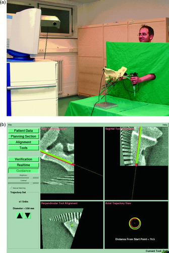 Figure 4. Set-up for Iso-C3D navigation. a) After placing the reference base on the iliac crest, an Iso-C3D scan was performed (100 images). b) The trajectories were planned in the 3D mode and drilling was performed. [Color versions available online.]