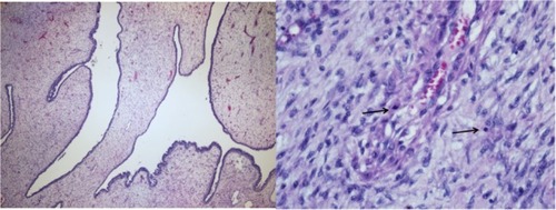 Figure 3 Microscopic study of phyllodes tumor.