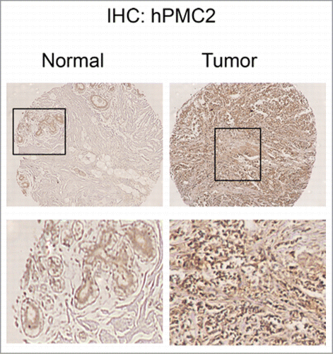Figure 6. hPMC2 expression in human breast tissue samples. Sections obtained from normal breast and breast tumors were stained for endogenous hPMC2 protein.