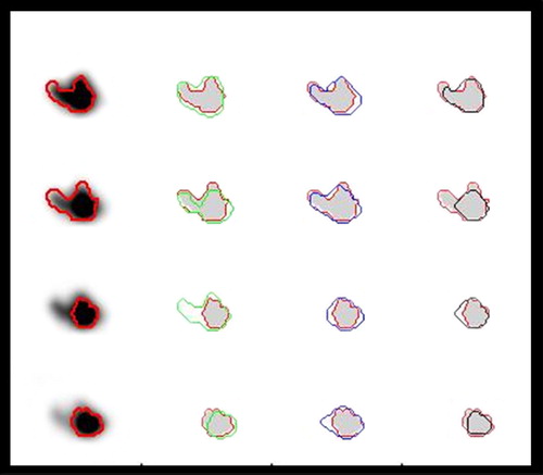 Figure 5. Illustration of the performances of different methods for tumour delineation based on PET. The reference contour (red) is drawn into the PET-images, and as references for delineation based on the Difference of Gaussians (DoG) (green), manual delineation (blue) and 50% of SUVpeak isocontour delineation (black). Moving from the upper to the lower row, four consecutive slices 1 mm apart are shown. The DoG-derived contours in row 3 are here too wide, but is correct 1 mm further up in the phantom. The isoSUV delineation here misses large parts of the protruding parts (top and second row).