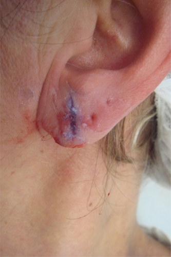 Figure 7 Reconstruction of an earlobe defect by removal of the epithelium by radiosurgery and appliation of acrylic tissue glue.