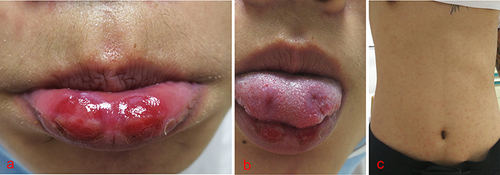 Figure 1 (a) Two erosive surfaces in the lower lip, with central uplift distributed symmetrically left and right. (b) Two ulcers of the same size could be seen at the corresponding part of the front part of the tongue. (c) Fuzzy infiltrating erythema in front and back of the trunk.