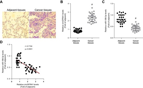 Figure 1 CircGFRA1 was highly expressed and miR-143-3p was lowly expressed in NSCLC tissues. (A) The pathological changes of NSCLC tissues were detected by HE staining. (B) The expression of circGFRA1 in NSCLC and adjacent tissues was detected by RT-qPCR, #p<0.01 compared with adjacent tissues. (C) The expression of miR-188-3p in NSCLC and adjacent tissues was detected by RT-qPCR, #p<0.01 compared with adjacent tissues. (D) The correlation analysis of circGFRA1 and miR-188-3p levels in 30 NSCLC tissues.