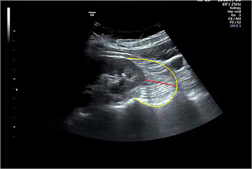 Figure 2 Echocardiographic perirenal fat thickness. The perirenal fat located between the surface of the kidney and the yellow curve. The perirenal fat thickness is marked by the red line.