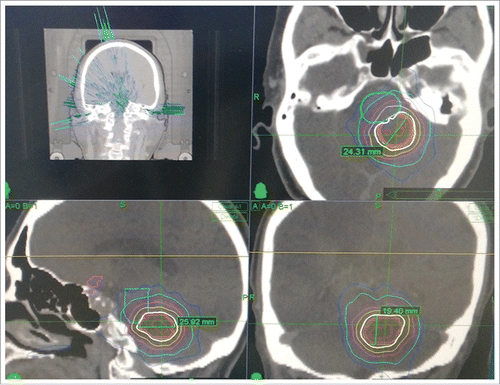 Figure 2. Radiosurgery plan for the CyberKnife treatment that was administered (18 Gy in three fractions, 71% of isodose curve).