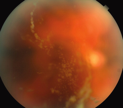 FIGURE 1. (Case 1) Vitreous infiltrate at presentation showing strings of opacities.
