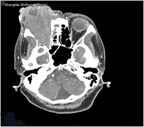 Figure 2. Orbit computed tomography (CT) with intravenous contrast showed a 7.5-cm- × 4.1-cm-sized mass arising from the right orbit. The mass extended toward the right-sided maxillary sinus, ethmoid sinus, and frontal sinus.