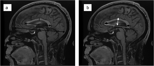 Figure 2. (a) the black double-ended arrows show the measurement of the anterior-posterior dimension of the corpus callosum and the fronto-occipital dimension of the brain respectively. (b). The white double-ended arrow shows the measurement of the height of the corpus callosum, while the black diamond-shaped arrows show the measurement of the thickness of the genu and splenium, respectively.