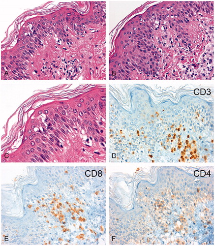 Figure 4. Immunohistochemical analysis of lymphocytic infiltrates in the skin biopsies. H&E sections of the skin biopsy taken in February 2011 (A, 200-fold) and November 2011 (B, 200-fold) are shown. After regional hyperthermia concurrent with the skin erythema, a chronic interface dermatitis with focal epithelial lymphocytic infiltrates was found in both biopsies. The magnified image (C, 630-fold) revealed epidermal spongiosis, vacuolization of basal cell layers, and dyskeratotic keratinocytes with few apoptotic bodies. The immunohistochemistry showed an infiltration by CD3+ T-lymphocytes (D) which consisted predominately of CD8+ cytotoxic T lymphocytes (E) and fewer CD4+ T helper cells (F).