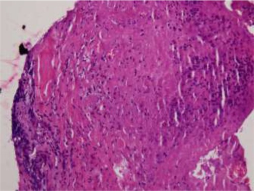 Figure 4 Another scleral tissue biopsy predominantly containing fibrosis with necrobiosis of collagen and scattered necrotic cellular debris of inflammatory cells (hematoxylin-eosin; original magnification: ×200).